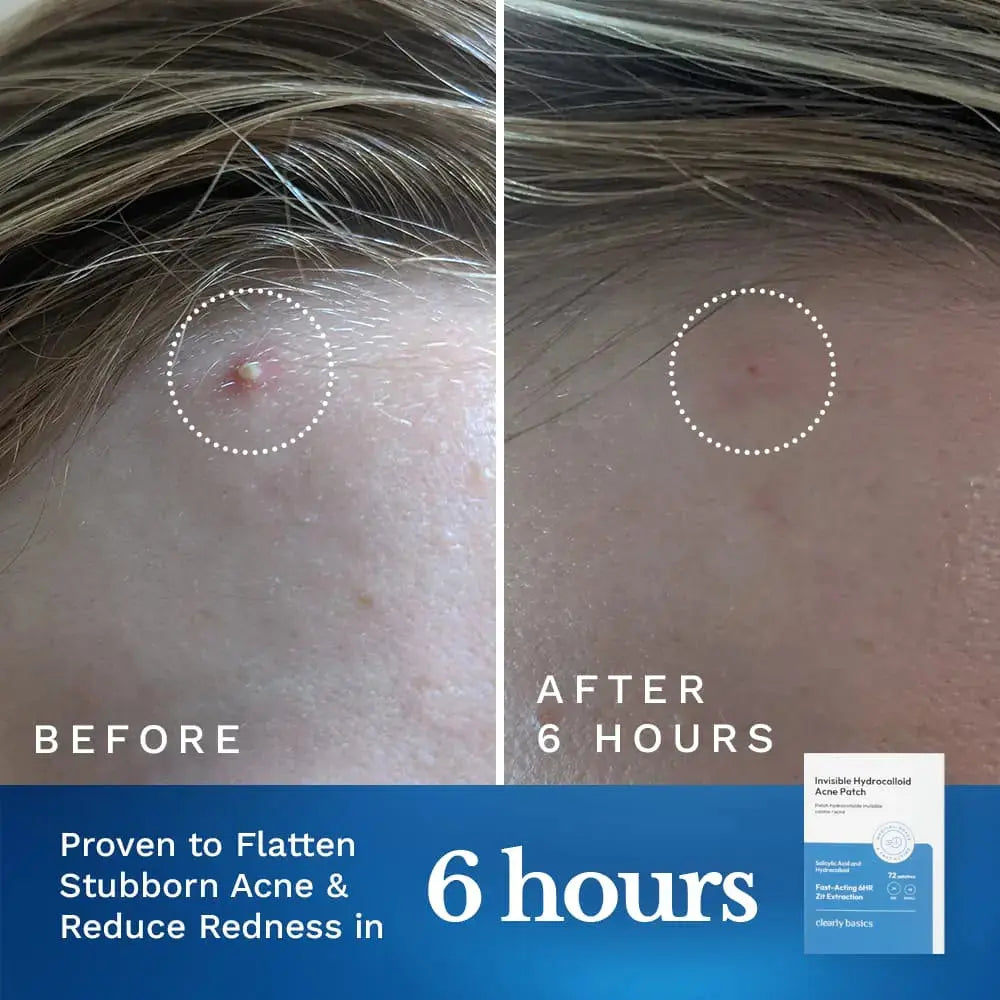 Invisible Acne Patch Clearly Basics
